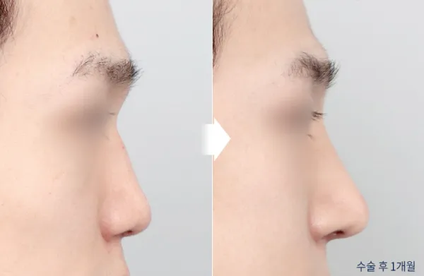 Before/After