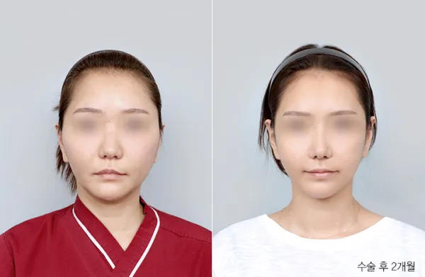 Before/After
