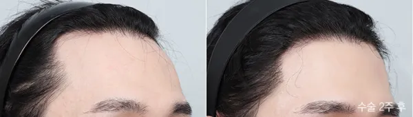 Before/After