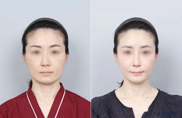 Before/After