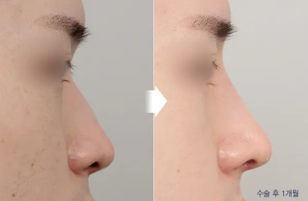 Before/After