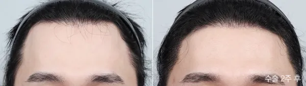 Before/After