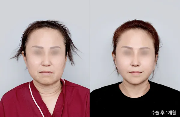 Before/After