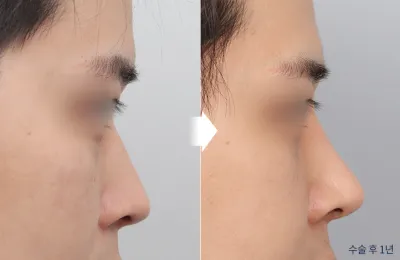 Before & After