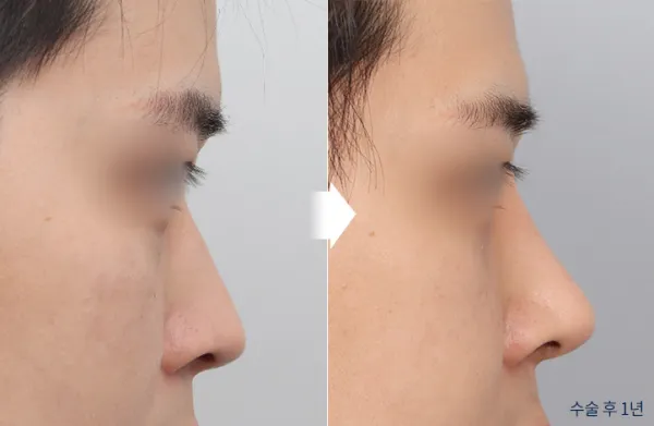 Before/After