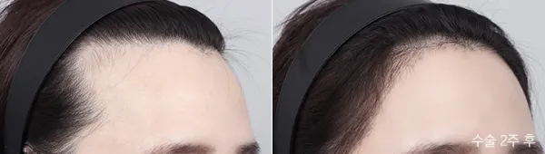 Before/After