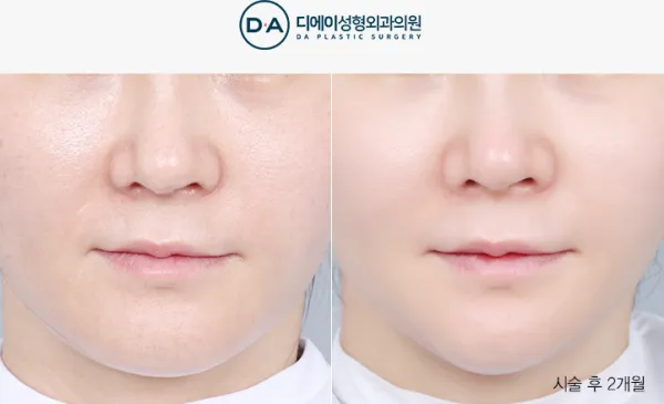 Before/After