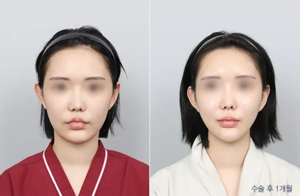 Before/After