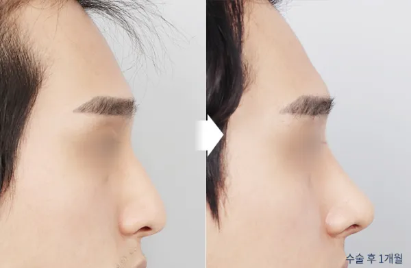 Before/After