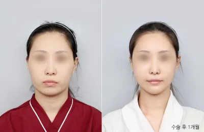 Before & After