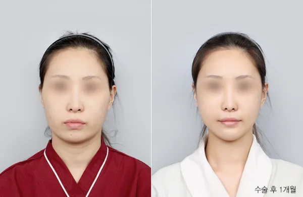 Before/After