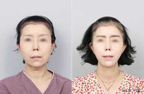 Before/After