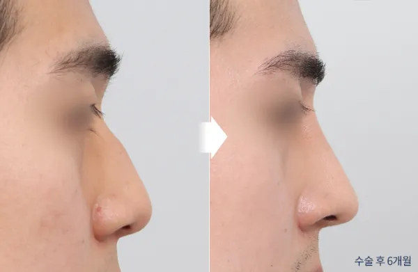 Before/After