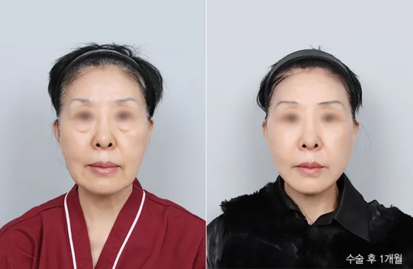 Before/After