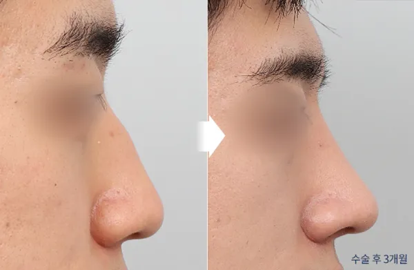 Before/After