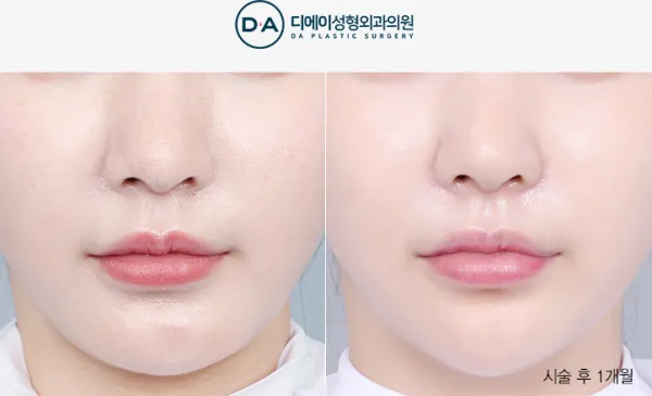 Before/After