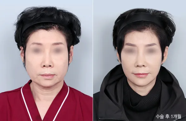 Before/After