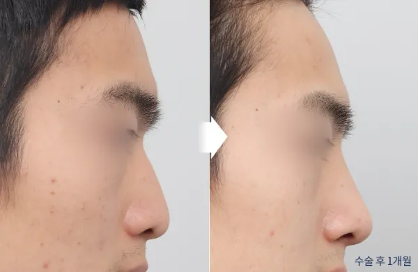 Before/After