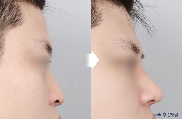Before/After