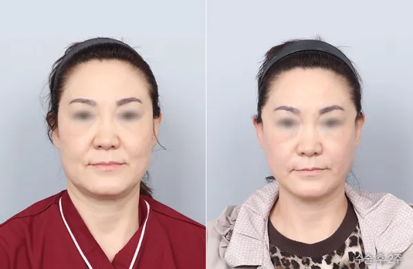 Before/After
