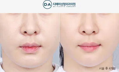 Before & After