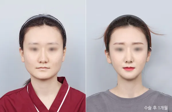 Before/After