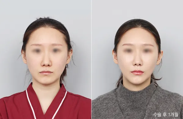 Before/After