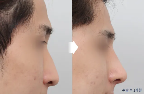 Before/After