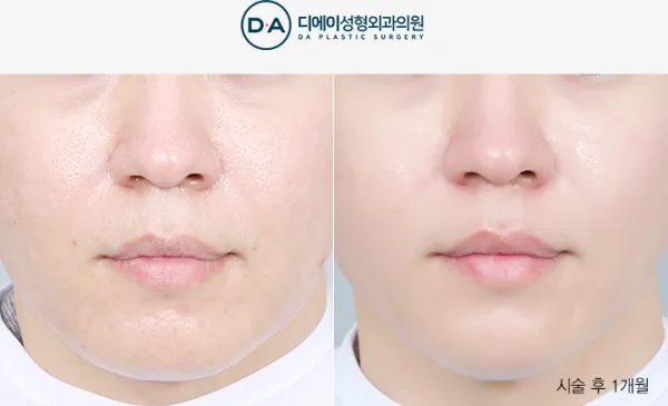 Before/After