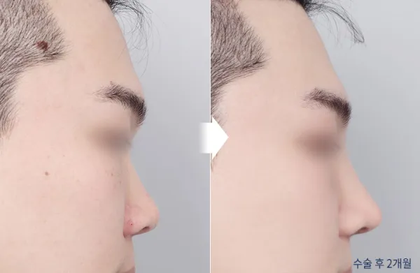 Before/After