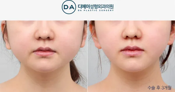 Before/After
