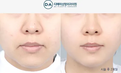 Before & After