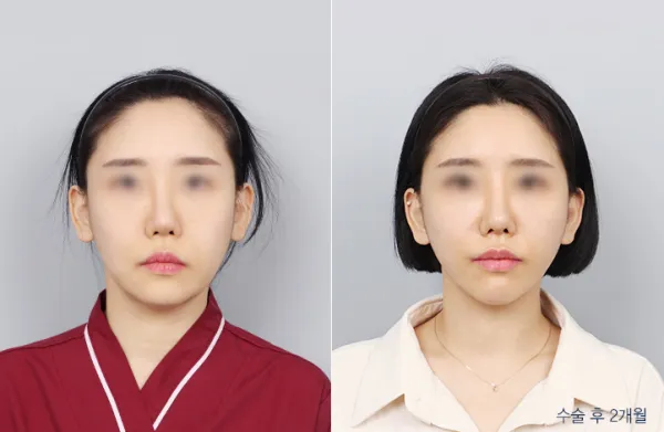 Before/After