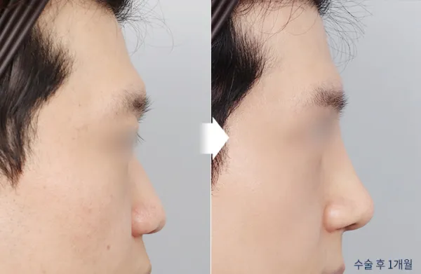 Before/After