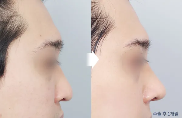 Before/After