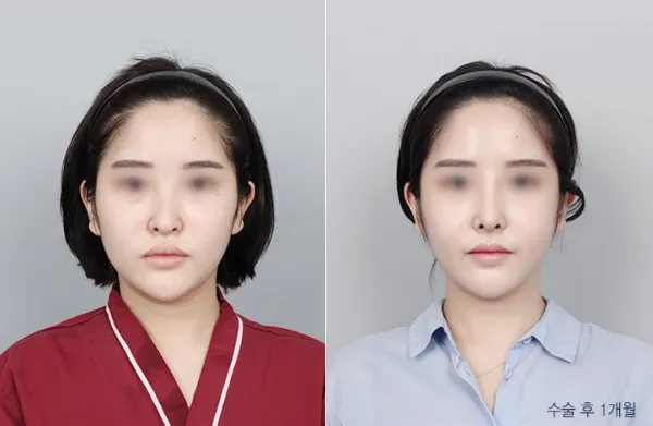 Before/After