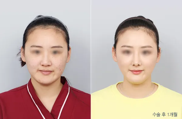 Before/After