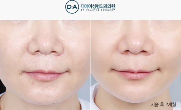 Before/After