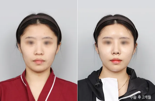 Before/After