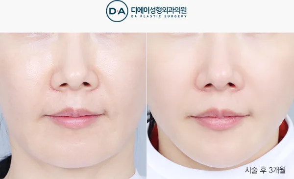 Before/After