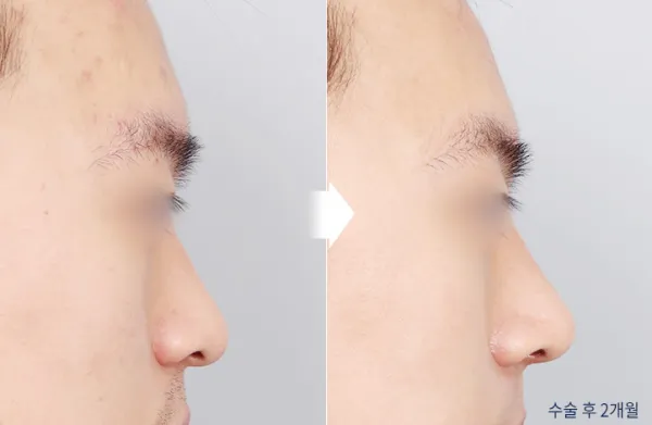 Before/After