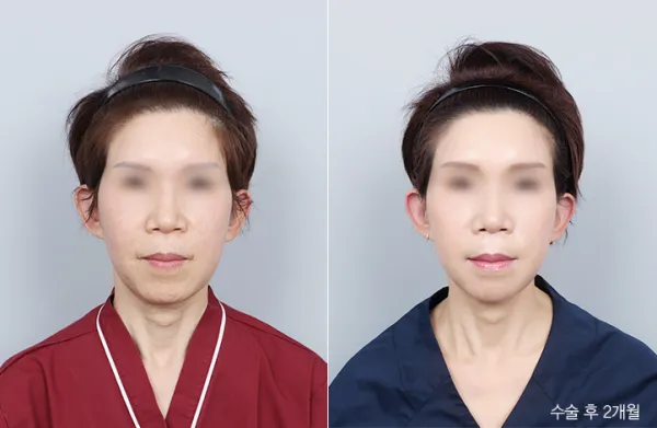 Before/After