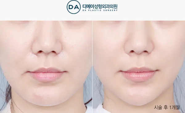 Before/After
