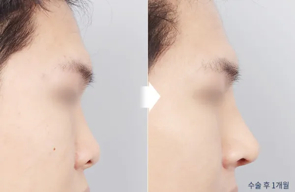 Before/After