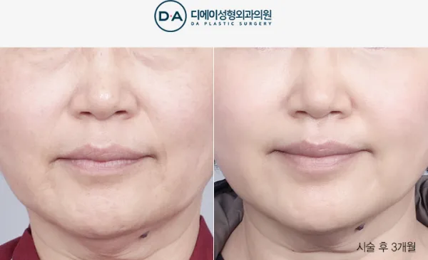 Before/After