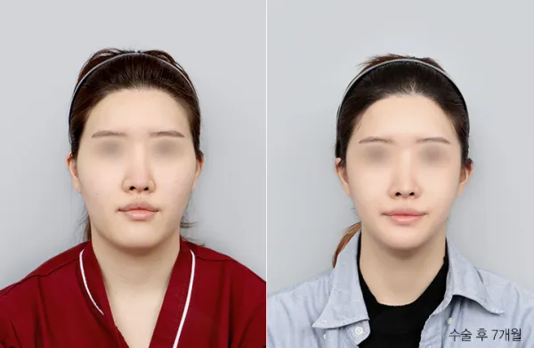 Before/After