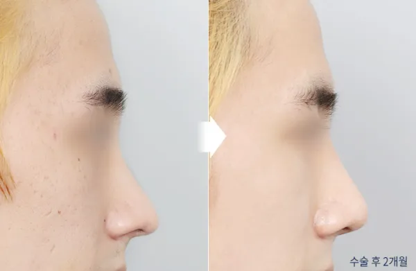 Before/After