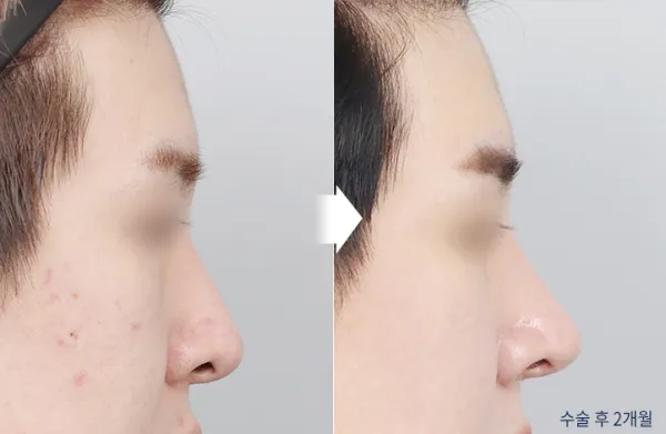 Before/After