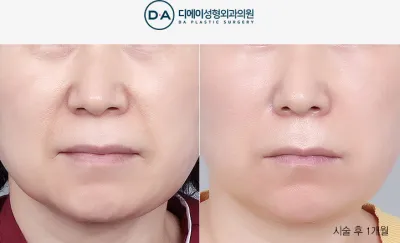 Before & After
