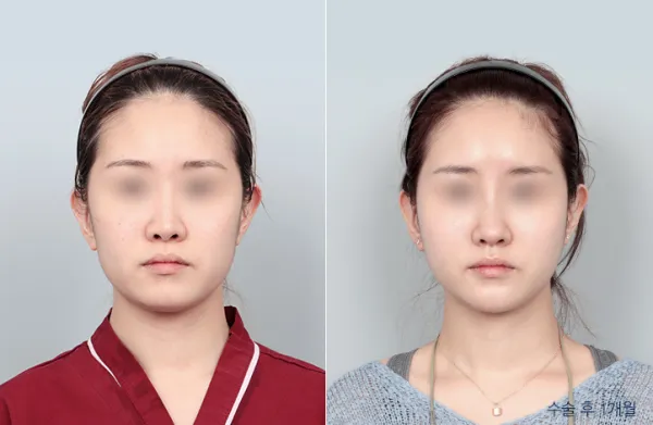 Before/After